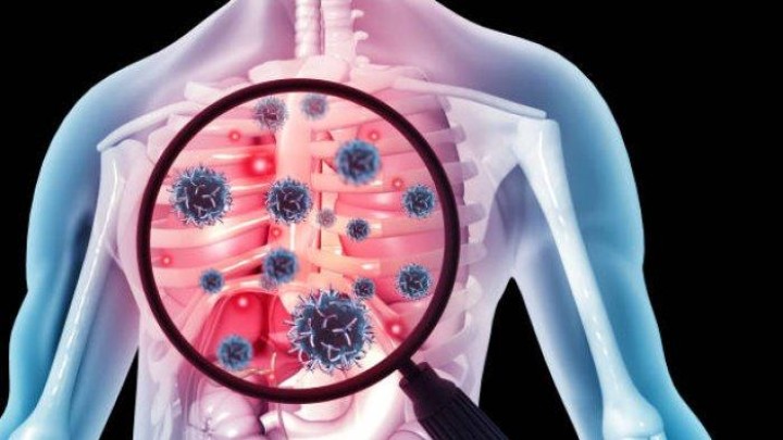 Benarkah Kelainan Paru yang Tidak Diobati Memicu Terjadinya Kanker Paru? Begini Kata Dokter