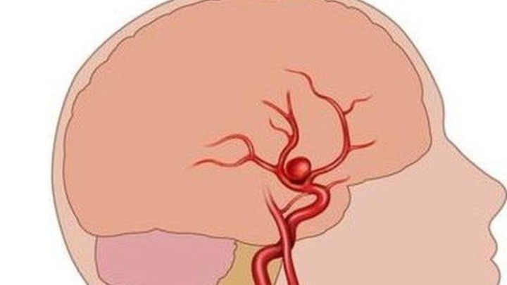 Ketahui Penyebab Utama Aneurisma dan Pertolongan Pertama yang Harus Dilakukam
