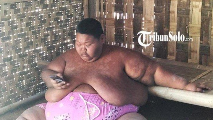Pria Obesitas Asal Sragen, Sugandi Berbobot 165 Kg Bisa Makan hingga 8 Porsi Sehari